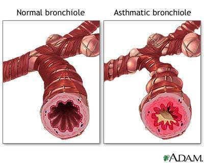 Asthma Caused by bronchial inflammation