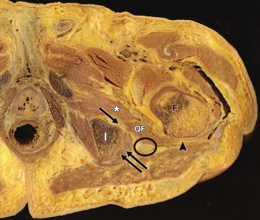 Kassarjian et al. Fig. 1 Cadaver of 69-year-old man with normal anatomy of quadratus femoris muscle. Photograph shows axial gross anatomic relations.