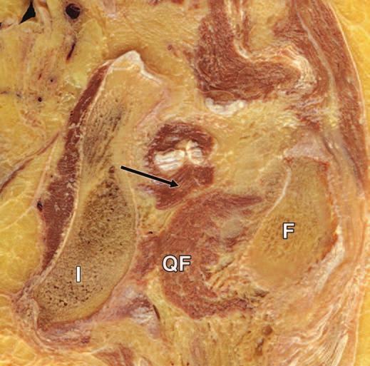 quadratus femoris muscle. F = femur, QF = quadratus femoris, I = ischial tuberosity. Fig. 2 Cadaver of 69-year-old man with normal anatomy of quadratus femoris muscle.