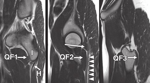 Sagittal T2-weighted clinical MR images from medial to lateral show origin (QF1), belly (QF2), and insertion (QF3) of quadratus femoris