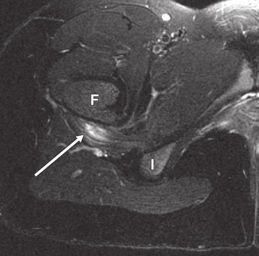 6 13-year-old girl with left hip pain and normal hip arthrogram and normal anatomy of quadratus femoris muscle.
