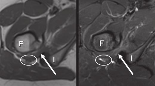 Kassarjian et al. Fig. 9 73-year-old woman with right posterior hip and buttock pain and impingement of quadratus femoris.