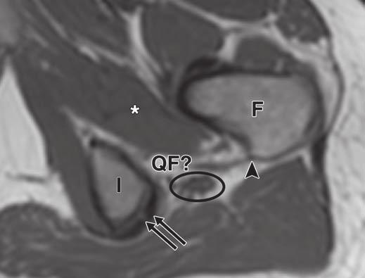 These are typical findings of impingement of quadratus femoris. Oval indicates sciatic nerve. F = femur, I = ischium. Fig.