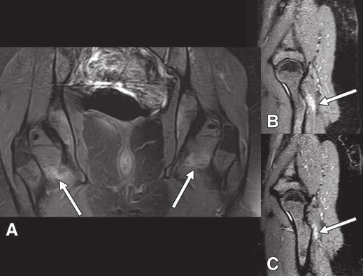 Axial T1-weighted (left) and fat-suppressed T2-weighted (right) images show crowding of fibers and edema in fibers (arrows) of quadratus femoris muscle.