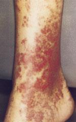org Source: Dartmouth medical photo library Extrahepatic manifestations of HCV Cryoglobulinemia (50%) Low