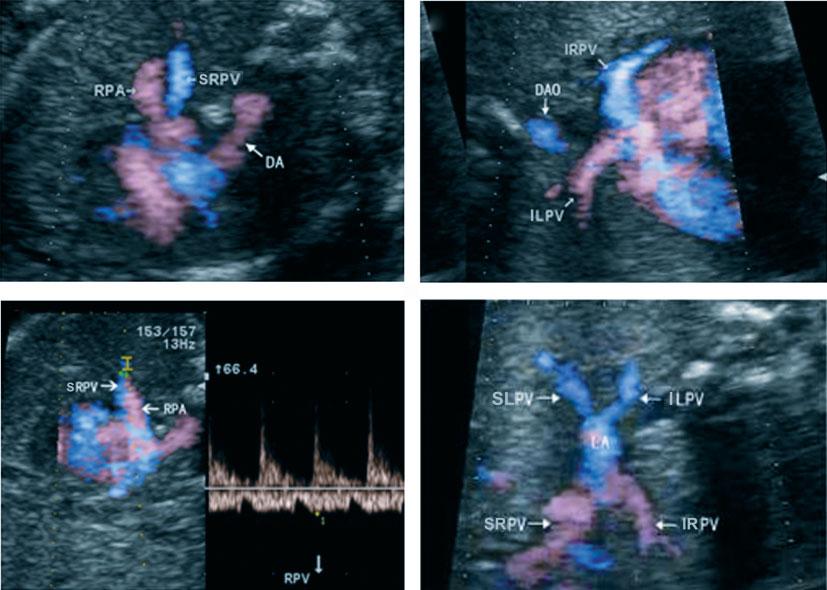 654 Dong et al. Figure 1 Visualization of fetal pulmonary veins in the four-chamber view by e-flow imaging in four 26-week fetuses.
