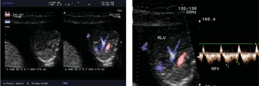 656 Dong et al. Figure 3 Fetal pulmonary veins visualized by e-flow imaging at 12 weeks of gestation.