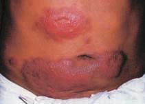 Signs of reactions include: Existing skin lesions become reddish and swollen; Painful reddish nodules appear; Peripheral nerves become painful, tender and swollen; Signs of nerve damage such as loss