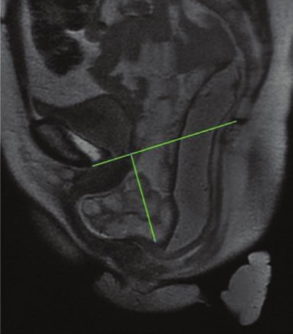 C, Images with evacuation: normally the anorectal junction widens. Reprinted with permission from Magnetic Resonance Imaging Clinics of North America 2013;21:427 445.