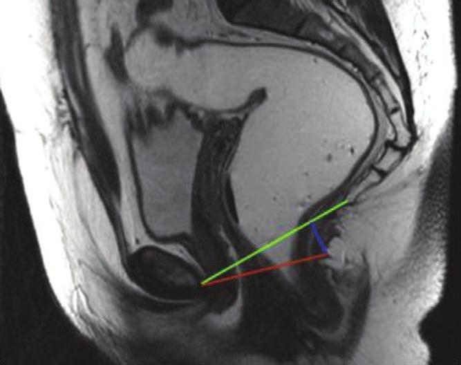 426 BORDEIANOU ET AL: DEFINITIONS FOR ARP and PF Terminology FIGURE 4. Pubococcygeal (green) line is the line drawn between the lower part of the pubis and the lowest coccygeal joint.