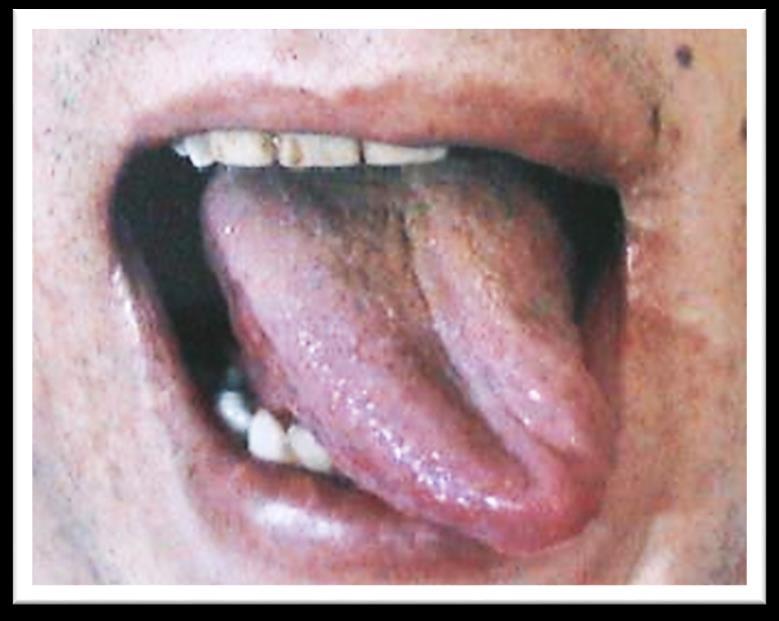 Lacerations of the tongue Clinical Notes Tongue-Tie