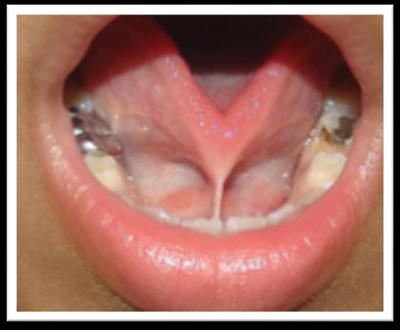hypoglossal nerve The protruded tongue deviates