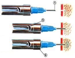 Intraosseous Anesthesia The Stabident System Step 3: Insert syringe needle through perforation and inject Watch for any backflow of anesthetic Intraosseous Anesthesia Reliable:
