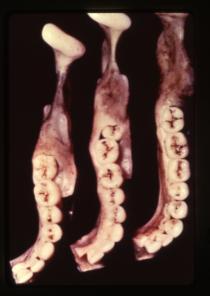 1994 Inferior alveolar nerve block Bisection technique: Unfortunately, anatomical structures vary widely Wide flaring mandible Wide flaring ramus Long (A P) ramus