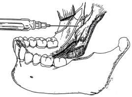 Go higher and deeper for a second injection? Troubleshooting The tooth is only partially numb!
