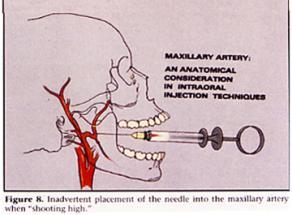 Risk higher incidence of positive aspiration Blanton PL & Roda RS, The anatomy of local anesthesia, CDA Jour, Vol 23 No 4, April 1995 Troubleshooting The tooth is only partially numb!