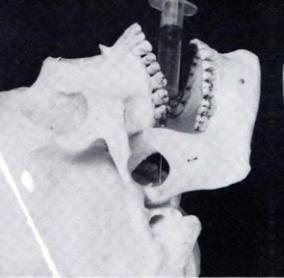 the opposite corner of the mouth Anterior posterior orientation Malamed, Handbook of