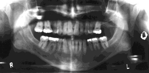 buccal nerve The risk of nerve injury with administration of prilocaine (Citanest) or articaine (Septocaine) may be reduced by using high mandibular division block techniques Gow-Gates technique