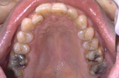 Buccal and palatal anesthesia of bicuspids and incisors 2.