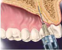 Explain all that you do to minimize the discomfort Maxilla: Nerve blocks The ASA palatal approach (P-ASA injection) To