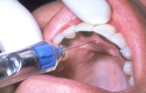 2007 Bilateral anterior superior alveolar nerve block The ASA palatal approach (P-ASA injection) 1.