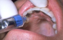 Computer-Controlled Delivery Systems The Wand : Single Tooth Anesthesia