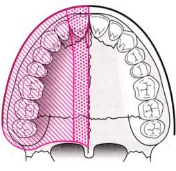 Complete maxillary division block With either approach, may