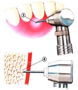 injection site See light tissue blanching Intraosseous Anesthesia The Stabident