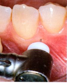 and between teeth Intraosseous Anesthesia The Stabident System Step 2: