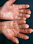 Psoriatic lesions are well circumscribed, circular, red papules or plaques with a grey or white silvery-grey, dry scale (papules: raised lesions < 1 cm; plaques: raised lesions > 1 cm in diameter).