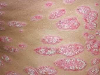CHRONIC PLAQUE PSORIASIS Well demarcated