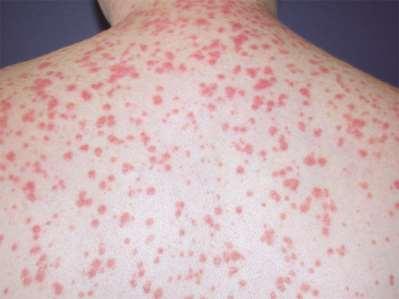 GUTTATE PSORIASIS Small, extensive round, scaly, red papules (like raindrops) appear commonly on trunk