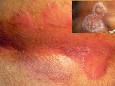FLEXURAL PSORIASIS Well demarcated red smooth plaques with little scale Often confused