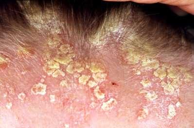 FACIAL PSORIASIS Common involvement includes forehead, hairline, external