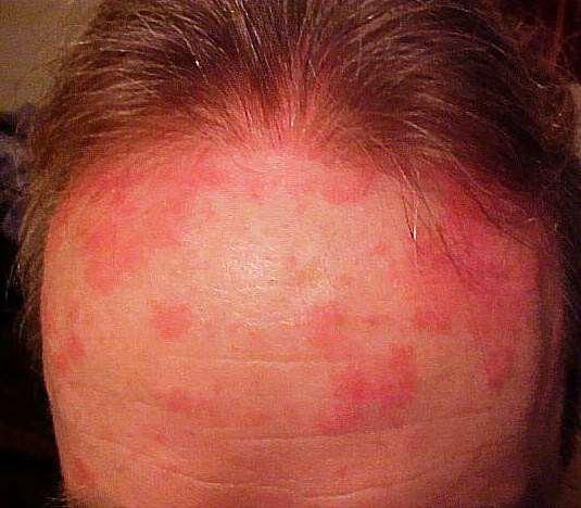 TREATMENT FOR FACIAL PSORIASIS Mild/moderate topical steroids