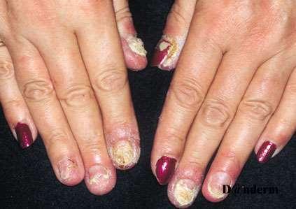 NAIL PSORIASIS 25-50% of all psoriasis sufferers have