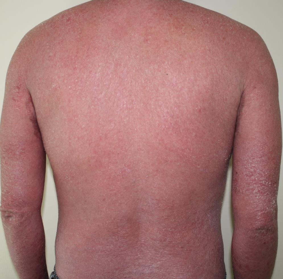 Acute form; Erythrodermic generalized erythema covering nearly the entire body surface area with