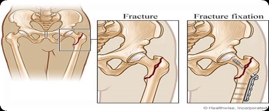 HIP FRACTURE Hip fractures are common in older adults. Manifestations are external rotation, muscle spasm, shortening of affected extremity, and severe pain in region of fracture.