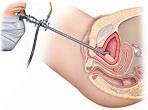 6 What does a cystoscope look like? Diagram 1: a rigid cystoscopy being performed on a woman What happens during a cystoscopy?
