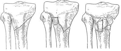 There are several types of proximal tibia fractures. The bone can break straight across (transverse fracture) or into many pieces (comminuted fracture).