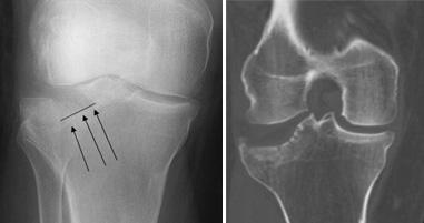 X-rays. The most common way to evaluate a fracture is with x-rays, which provide clear images of bone. X-rays can show whether a bone is intact or broken.