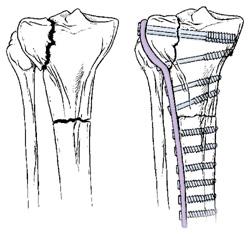In cases in which the upper one fourth of the tibia is broken, but the joint is not injured, a rod or plate may be used to stabilize the fracture.