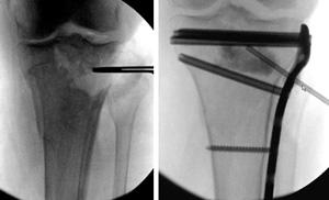 If the fracture enters the joint and pushes the bone down, lifting the bone fragments may be required to restore joint function.