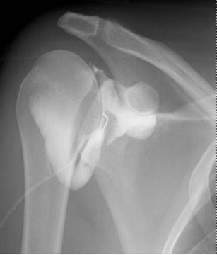 Eustace et al (1997) 38 blind shoulder injections steroid + radiographic contrast 42% accuracy in GH joint
