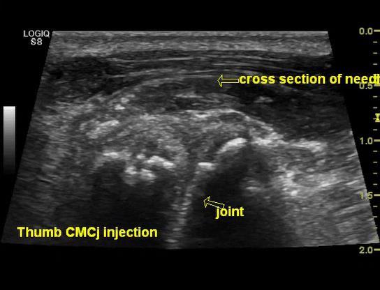 Raza et al (2003) Needle placement into small joints in early RA Compared 17