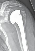 Glenohumeral Joint Arthritis Relatively uncommon Not as common as hip/knee/hand UK