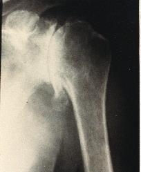 Causes of Glenohumeral Joint Arthritis Primary Unknown