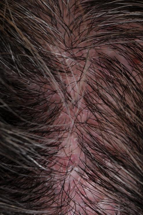 Lichen Planopilaris Uncommon lymphocytic scarring alopecia 2-8% of all visits to