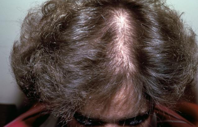 Introduction Common: By menopause about ½ of women experience hair loss Incidence increases with age Psychologically distressing: Women feel it is unnatural for their hair to