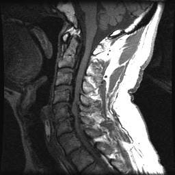 Disc Herniation Relatively rare in office setting Hyperflexion / trauma Hx: true radicular complaints» occasionally